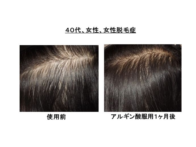 円形脱毛症　病院